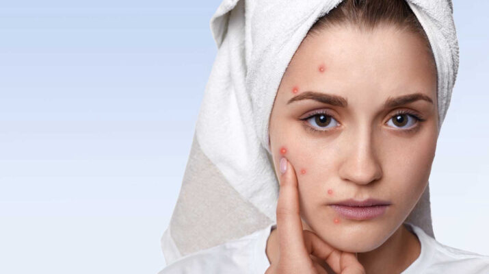 The Ultimate Skincare Guide for Acne Sufferers | The African Exponent.